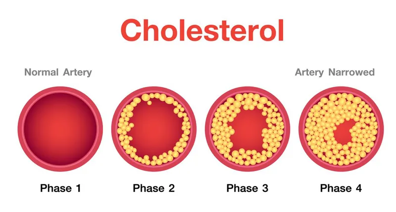 Diagram of an artery narrowing across four phases of cholesterol build-up