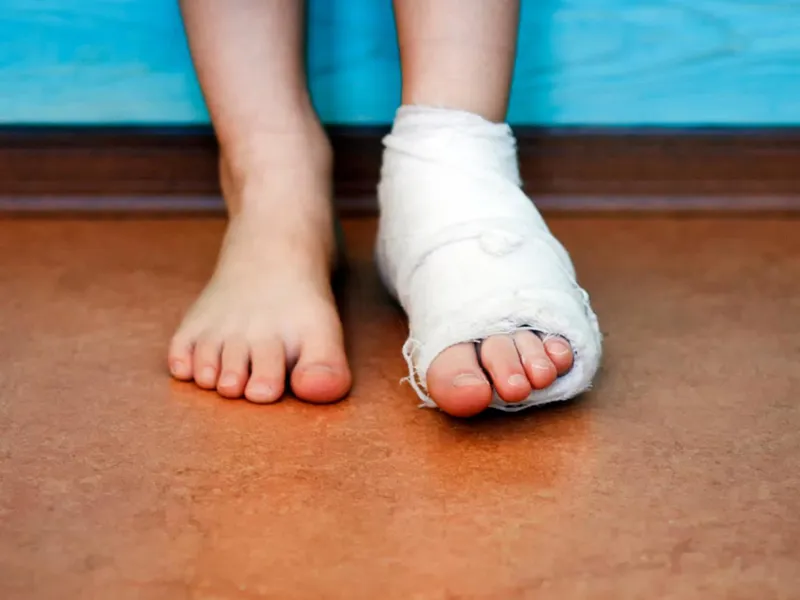 Child's foot in a plaster cast beside a bare foot