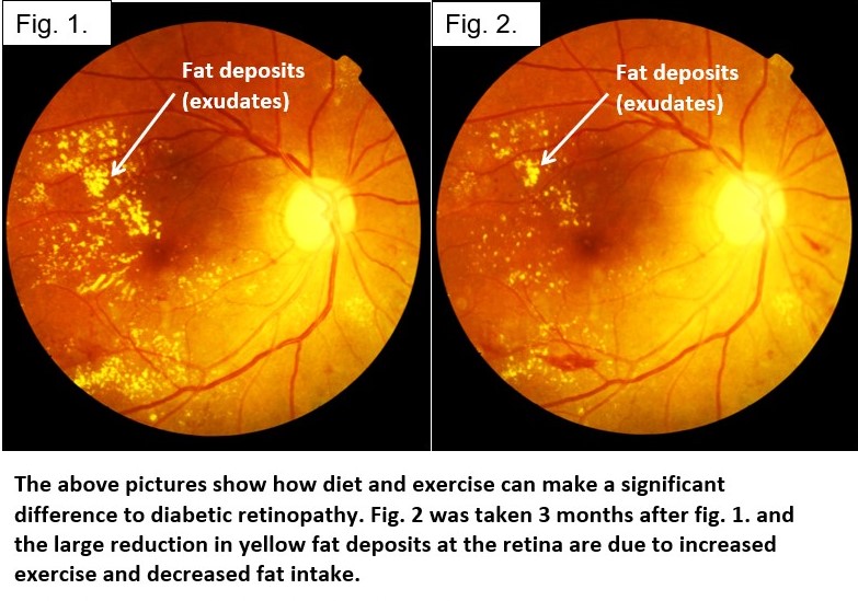 Two retinal photographs three months apart showing yellow fat deposits greatly reduced after increased exercise and decreased fat intake