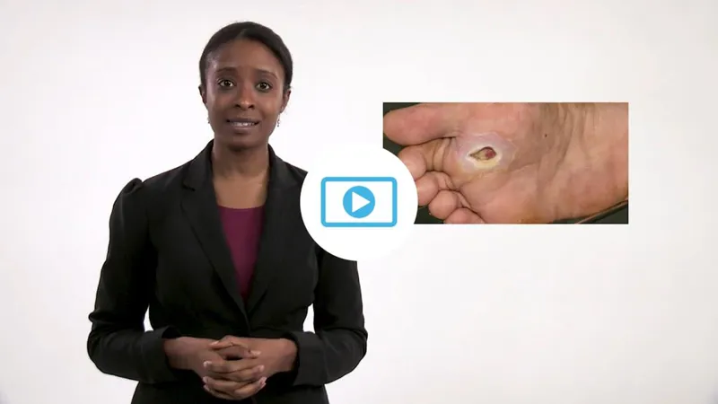 Presenter beside a close-up of a foot blister